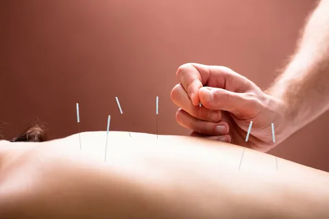 Acupuncture and The Way It Heals Since Ancient Times